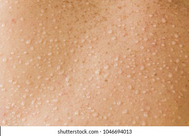 Beads of sweat are forming on the back. Disposition to sweating or perspiring.