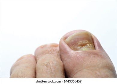 Beau's lines are deep grooved lines that run from side to side on the fingernail or the toenail.They may look like indentations or ridges in the nail plate. May be caused by a lack of Zinc / Calcium. - Shutterstock ID 1443368459
