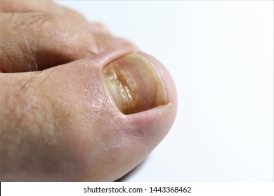 Beau's lines are deep grooved lines that run from side to side on the fingernail or the toenail.They may look like indentations or ridges in the nail plate. May be caused by a lack of Zinc / Calcium. - Shutterstock ID 1443368462