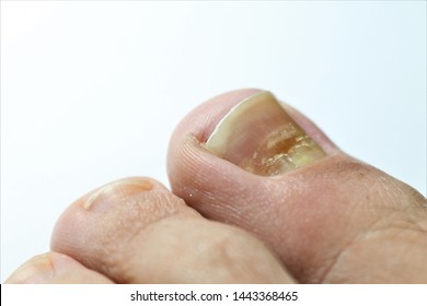 Beau's lines are deep grooved lines that run from side to side on the fingernail or the toenail.They may look like indentations or ridges in the nail plate. May be caused by a lack of Zinc / Calcium. - Shutterstock ID 1443368465