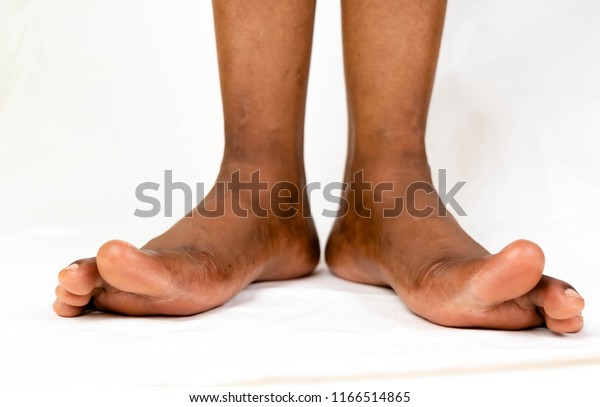 women with flat feet