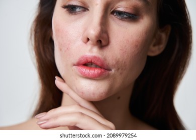 Beautiful Brunette Woman With Bad Skin Condition Looking Away While Standing