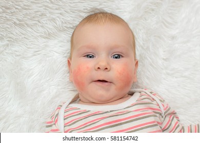 beautiful child allergic rash on the cheeks smiling on a white background - Shutterstock ID 581154742