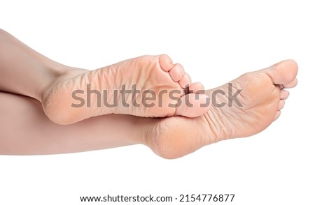 beautiful elegant female legs with dry and rough skin on the soles and heels. Dry Female heels. woman with rough and dry skin on heels of her feet. Dry and cracked soles of feet, copy space