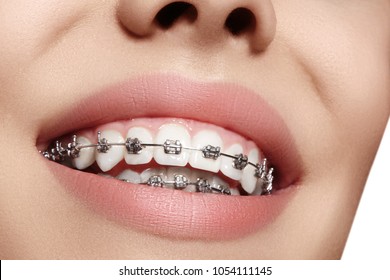 Beautiful macro shot of white teeth with braces. Dental care photo. Beauty woman smile with ortodontic accessories. Orthodontics treatment. Closeup of healthy female mouth - Shutterstock ID 1054111145