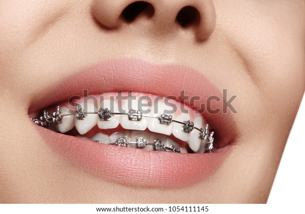 Beautiful macro shot of\
white teeth with braces. Dental care photo. Beauty woman smile with\
ortodontic accessories. Orthodontics treatment. Closeup of healthy\
female mouth