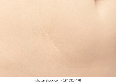 beautiful neat scar after appendectomy. scar on the skin after surgery.