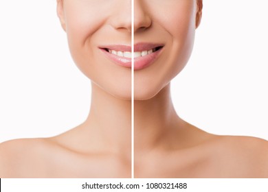 Beautiful plump Lips after filler injection collagen to increase the volume of the lips. Beauty concept. Female lips before and after augmentation procedure