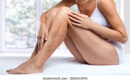 Beautiful slender woman sits on a couch in a spa salon. She shows varicose veins in the lower legs. 