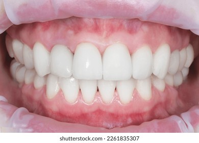 Beautiful smile and white teeth of a young woman. Matching the shades of the implants or the process of teeth whitening. High quality close-up photo