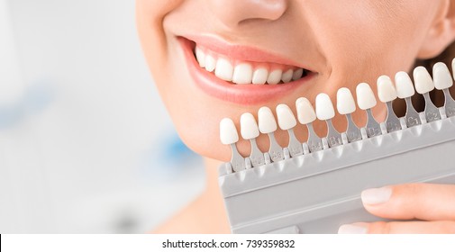 Beautiful smile and white teeth of a young woman. Matching the shades of the implants or the process of teeth whitening. - Shutterstock ID 739359832