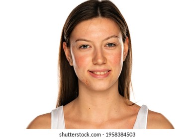 Beautiful smiling woman without makeup and problematic skin on a white background