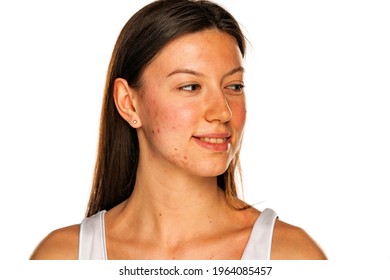 Beautiful smiling woman without makeup and problematic skin looking aside on a white background