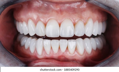 Beautiful Teeth With Ceramic Veneers Of The Patient's Upper And Lower Jaws