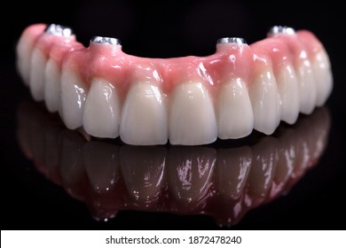 Beautiful upper teeth ceramic press ceramic crowns and veneers on the dental stone model zircon arch ceramic prothesis Implants . Dental restoration treatment clinic patient. oral surgery dentist - Shutterstock ID 1872478240