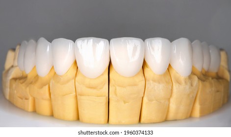 Beautiful upper teeth ceramic press veneers bleach of zircon arch prothesis Implants crowns. Dental restoration treatment clinic patient. Result of oral surgery procedure whitening dentistry - Shutterstock ID 1960374133