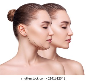 Beautiful woman before and after fat chin correction. - Shutterstock ID 2141612541