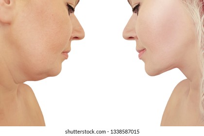 Beautiful Woman Double Chin Lift Before And After Correction Procedures