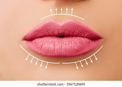 Beautiful Woman Lips Before Lip Filler Injections. Fillers, Cosmetology, Aesthetic Surgery And Lip Augmentation Concept