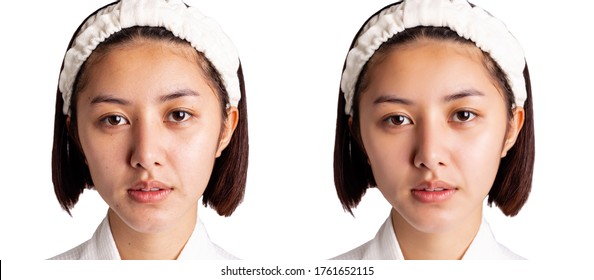 Beautiful Young Asian Woman Has Freckles, Dull Skin, Compare Another Side Beauty Girl Has Nice And Bright Skin On Face. Attractive Girl Get Happy After Get Facial Rejuvenation Cosmetology Concept. 