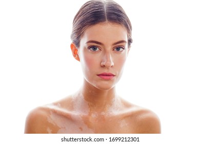 Beautiful Young Brunette Woman With Vitiligo Disease Isolated On White Positive Smiling, Model Problems Concept, Bad Tan Real Problem