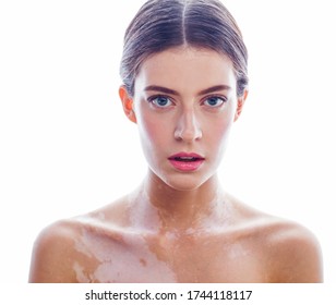 Beautiful Young Brunette Woman With Vitiligo Disease Isolated On White Positive Smiling, Model Problems Concept, Bad Tan Real Problem