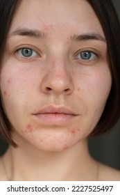 beautiful young girl with acne on her face. acne problem pimple on face a girl without makeup.chin acne problem

 - Shutterstock ID 2227525497
