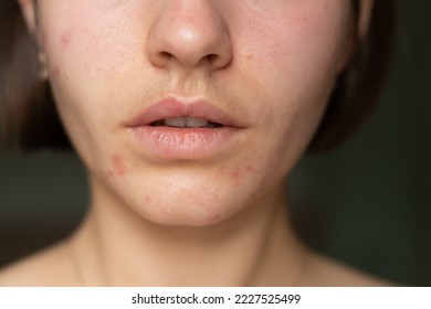 beautiful young girl with acne on her face. acne problem pimple on face a girl without makeup.chin acne problem

 - Shutterstock ID 2227525499