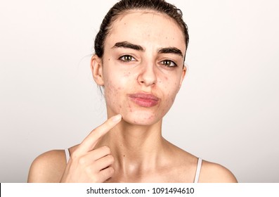 beautiful young girl with problematic skin, acne problem concept