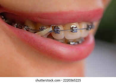 Beautiful Young Woman With Brackets On Teeth Close Up.