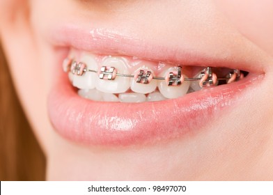 Beautiful young woman with brackets on teeth close up