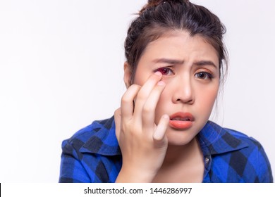 Beautiful Young Woman Get Allergic To Contact Lenses. Young Lady Gets Hurt, Painful Or Irritated Eyes. Girl Gets Conjunctivitis From Dirty Contact Lenses. It Is First Time To Use It. Isolated On White