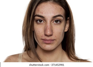 beautiful young women with problematic skin