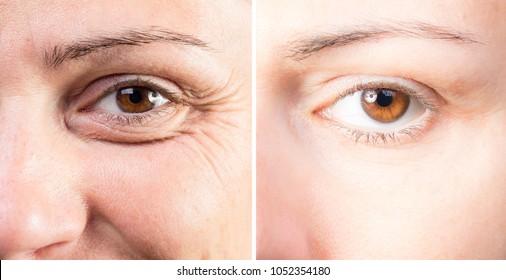 Beauty care to reduce wrinkles and eye bags