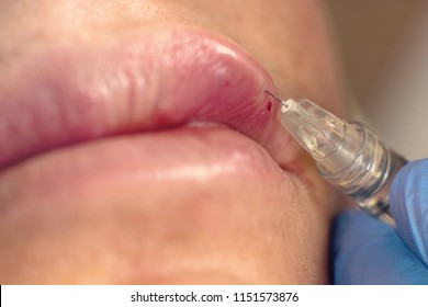 Beauty injections Close Up. Lip filler injection.