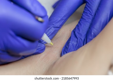 In A Beauty Salon, Close-up, The Tip Of A Hair Electrolysis Device, Where The Doctor Inserts A Needle Into The Hair Follicle