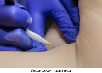 In A Beauty Salon, Close-up, The Tip Of A Hair Electrolysis Device, Where The Doctor Inserts A Needle Into The Hair Follicle