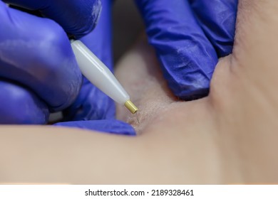 In A Beauty Salon, Close-up, The Tip Of A Hair Electrolysis Device, Where The Doctor Inserts A Needle Into The Hair Follicle