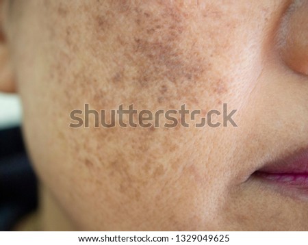 Beauty Skincare and health concept. The problem of dark spots melasma pigmentation on the face of asian woman that makes them lack confidence . 