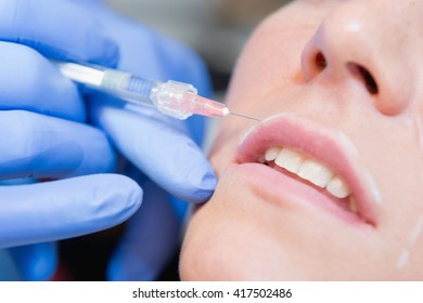 Beauty treatment with hyaluronic acid on upper lip, selective focus - Shutterstock ID 417502486