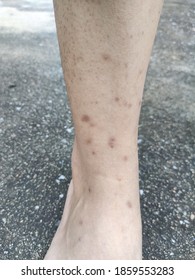 Bed Bug Bite Marks On Skin