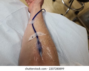 Bedford, NS, CAN, September 23, 2022 - A Needle In The Arm On A Man That Is Getting IV Medication. The IV Is Taped Down And The Arm Is Stretched Out To Allow For The Methylene Blue Medicine To Flow.