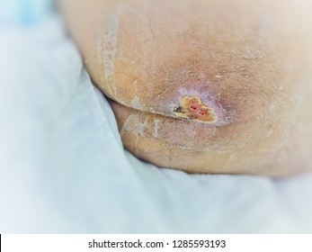 Bedsore, Pressure Ulcer,  Wound,Wounds Caused By Illness.