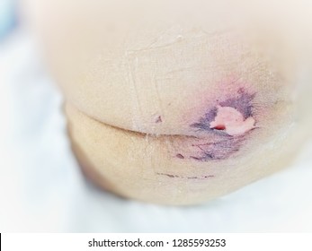 Bedsore, Pressure Ulcer,  Wound,Wounds Caused By Illness.