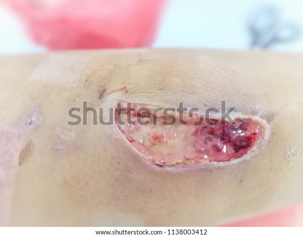 Bedsore,\
Pressure ulcer,  Wound,Wounds caused by\
illness.