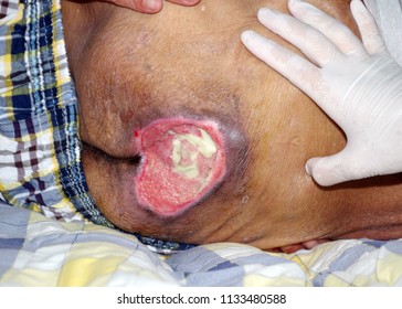 Bedsores ,Decubitus Ulcer ,Pressure Ulcer