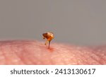 bee sting close-up stuck into human skin after being bitten by a dangerous insect