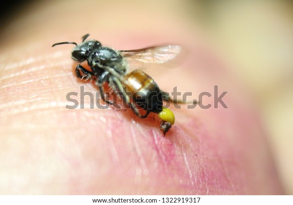 Bee Sting Man\'s Hand. It buried the sharp\
bee sting with a bag on his hand and\
died.