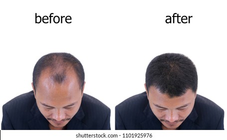 Before And After Bald Head Of A Man .