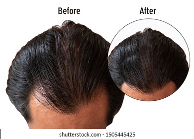 Hair Transplantation Before After Gorseller Stok Fotograflar Ve